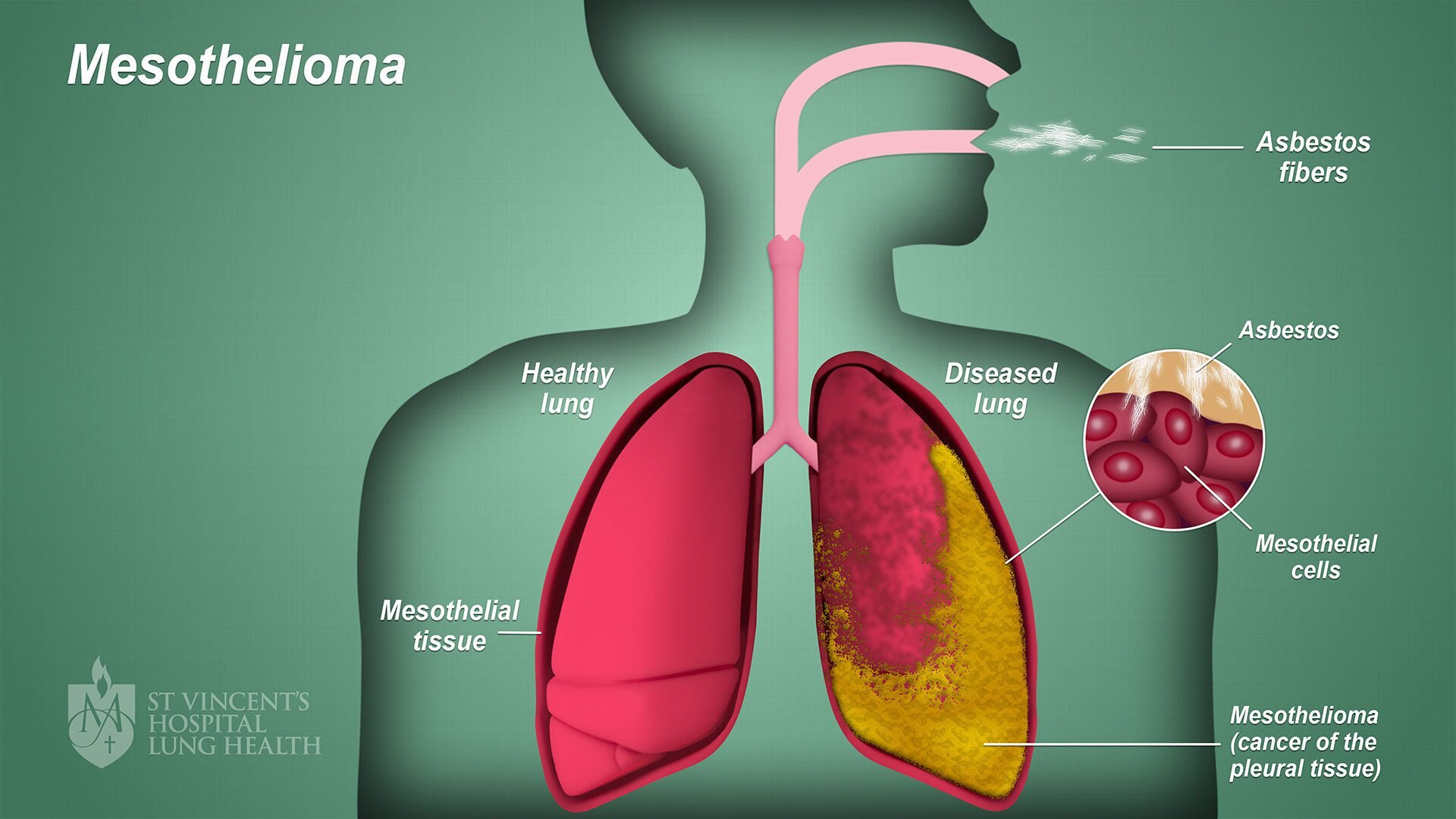 mesothelioma-trial-attorney_2